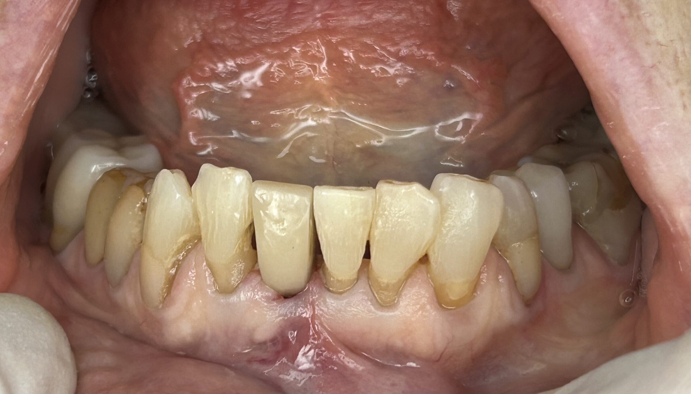 Single Tooth Implant Restoration — after