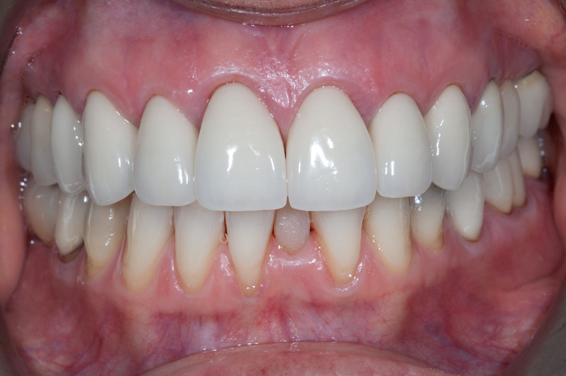 Full Smile Makeover with Porcelain Veneers — after