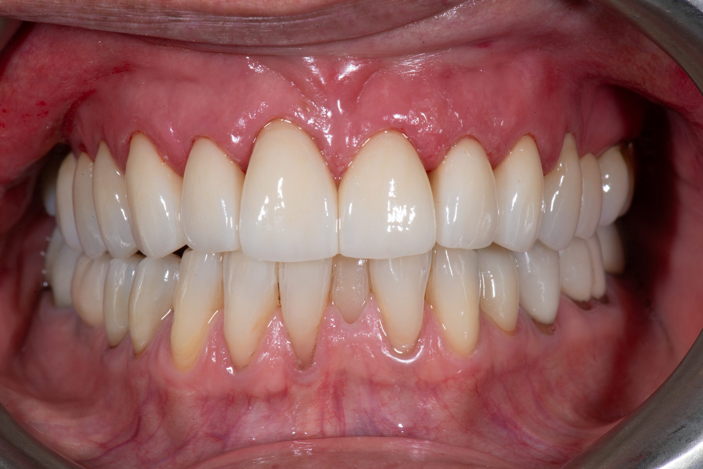 Full Smile Makeover with Porcelain Veneers — before