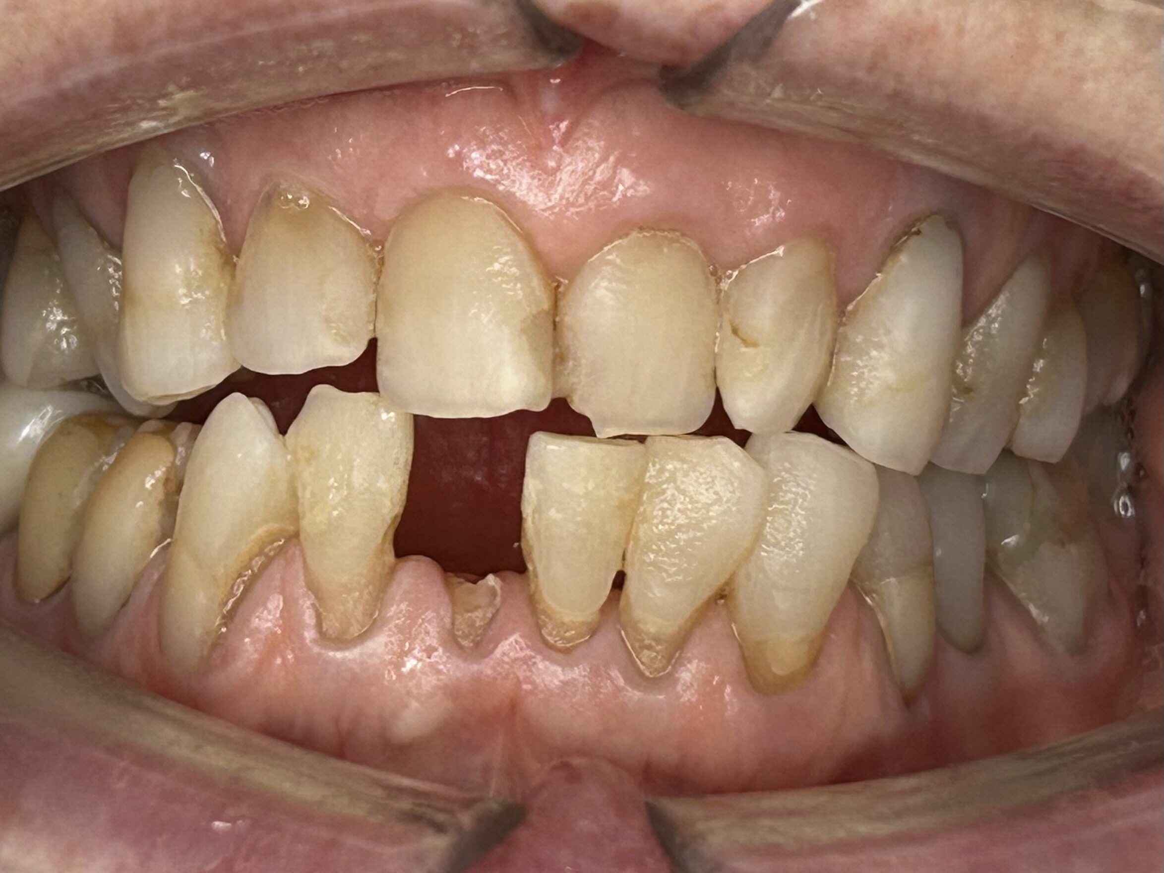 Single Tooth Implant Restoration — before