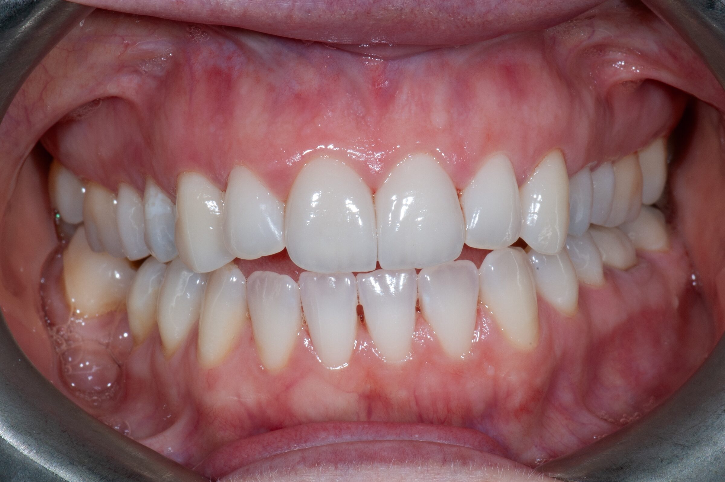 Professional Teeth Whitening — after