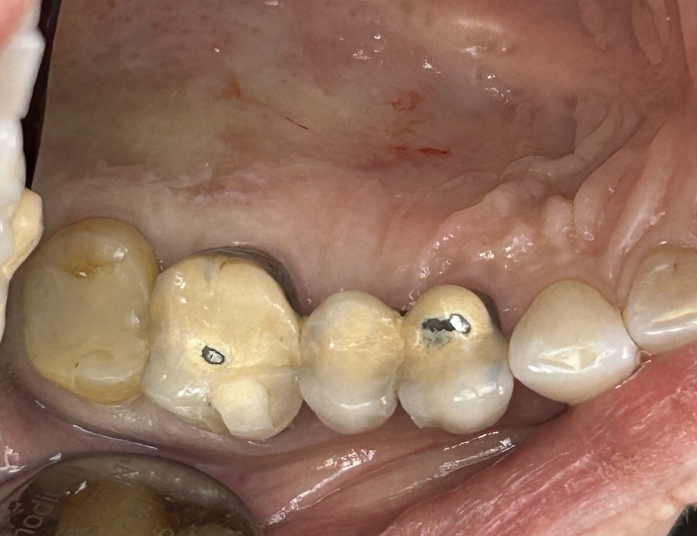 Restoring a Cracked Molar with a Crown — after