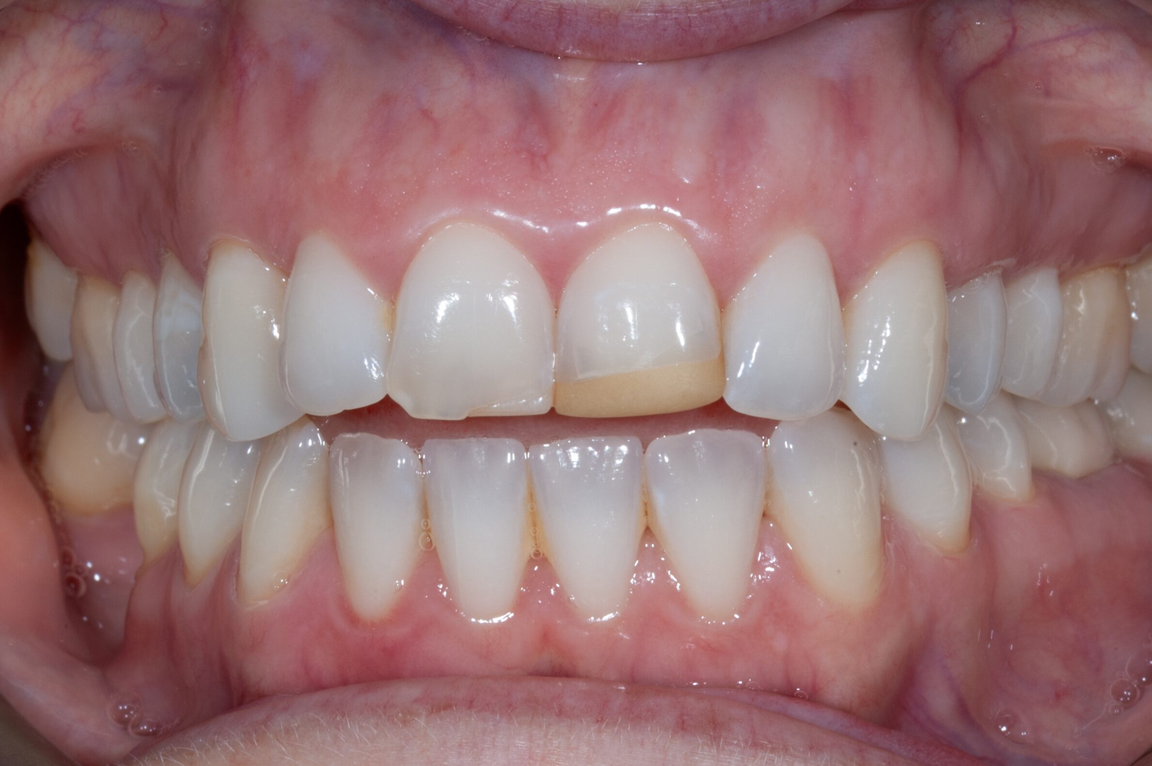 Professional Teeth Whitening — before