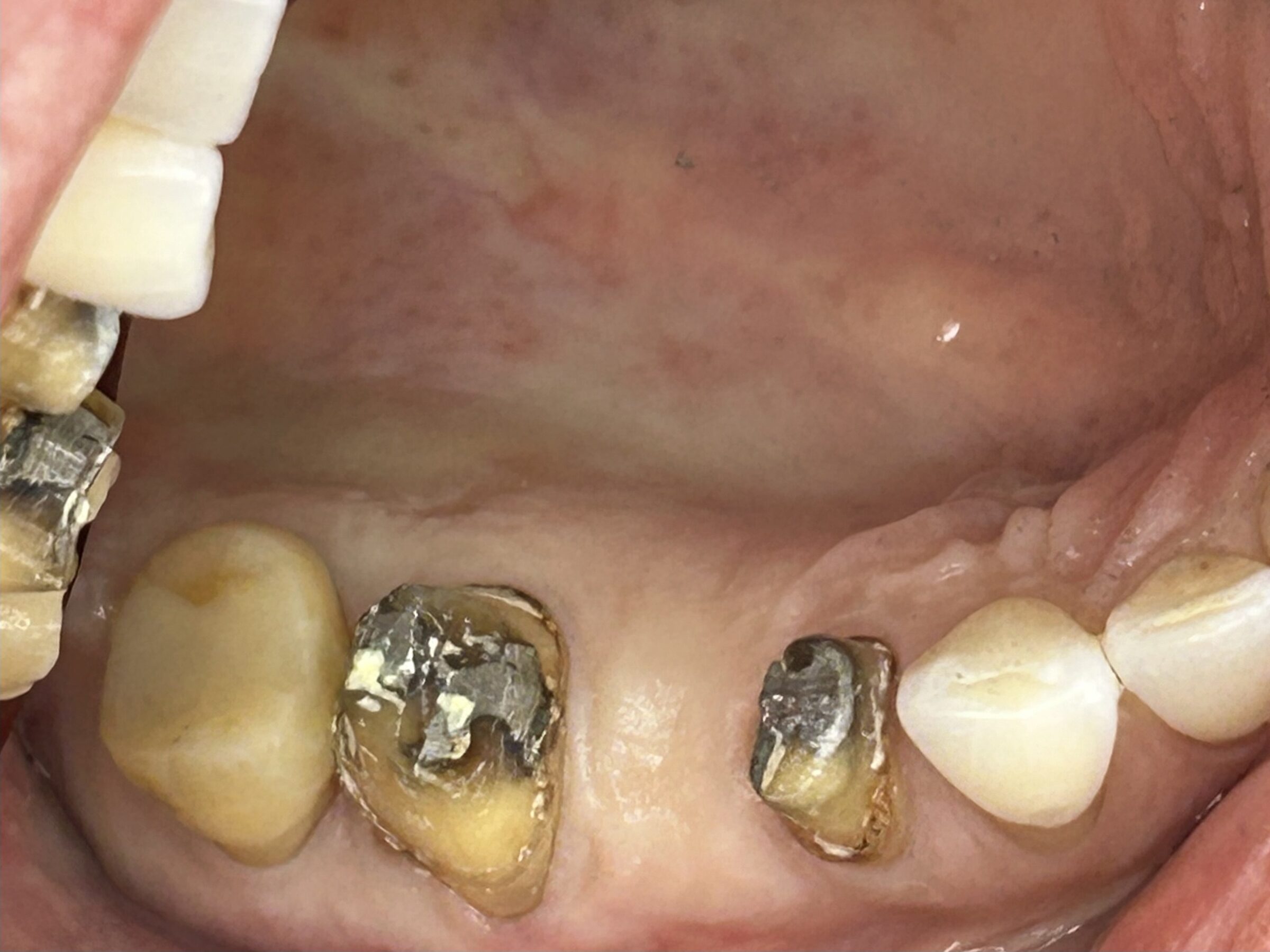 Restoring a Cracked Molar with a Crown — before