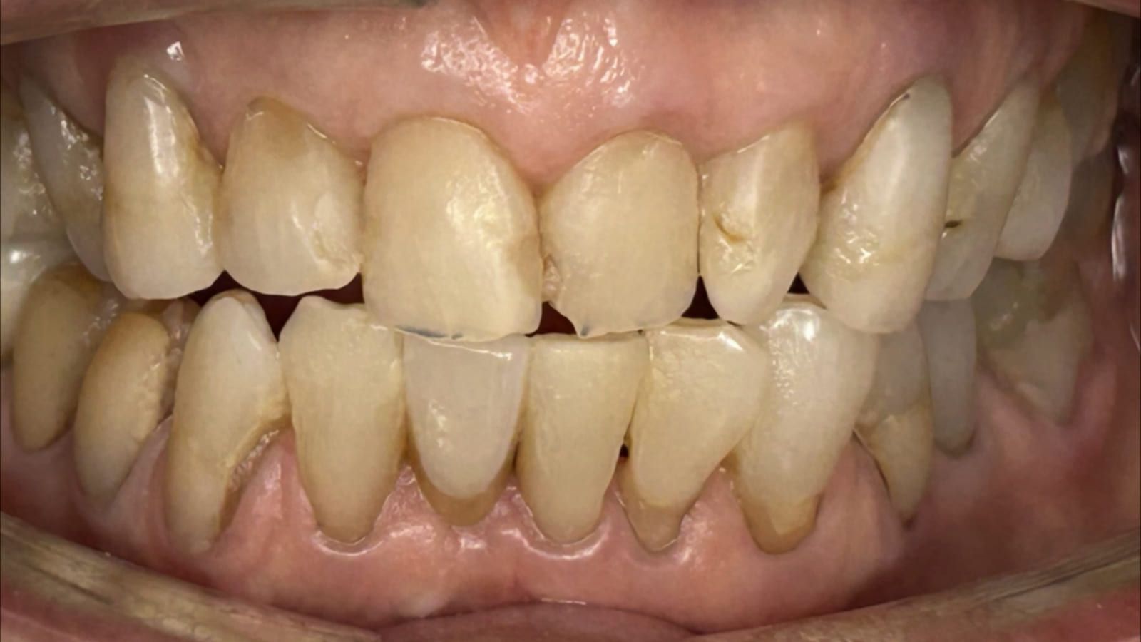 Immediate Implant for a Fractured Lower Incisor — after treatment