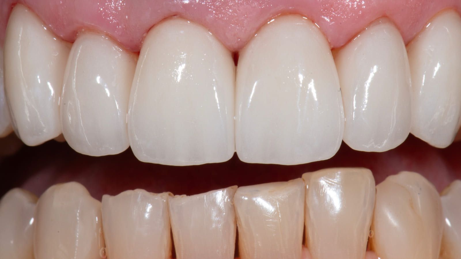 Porcelain Restorations Replacing Failing Resin — after treatment