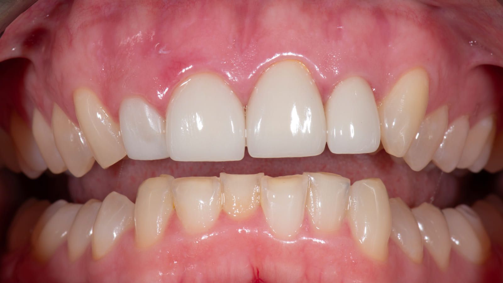 Correcting Four Ill-Fitting Front Crowns — after treatment