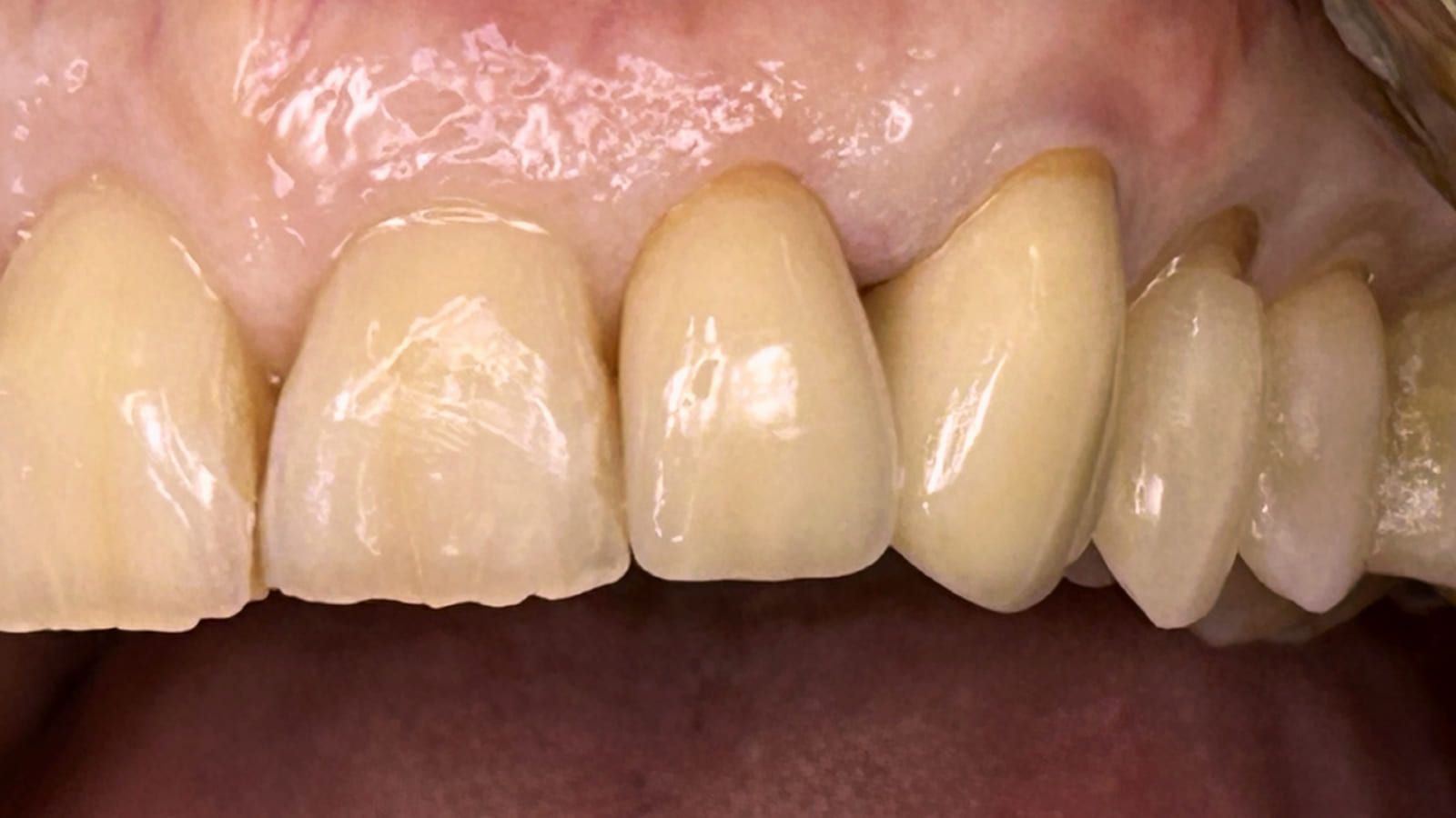 Aesthetic Improvement with Two Crowns — after treatment