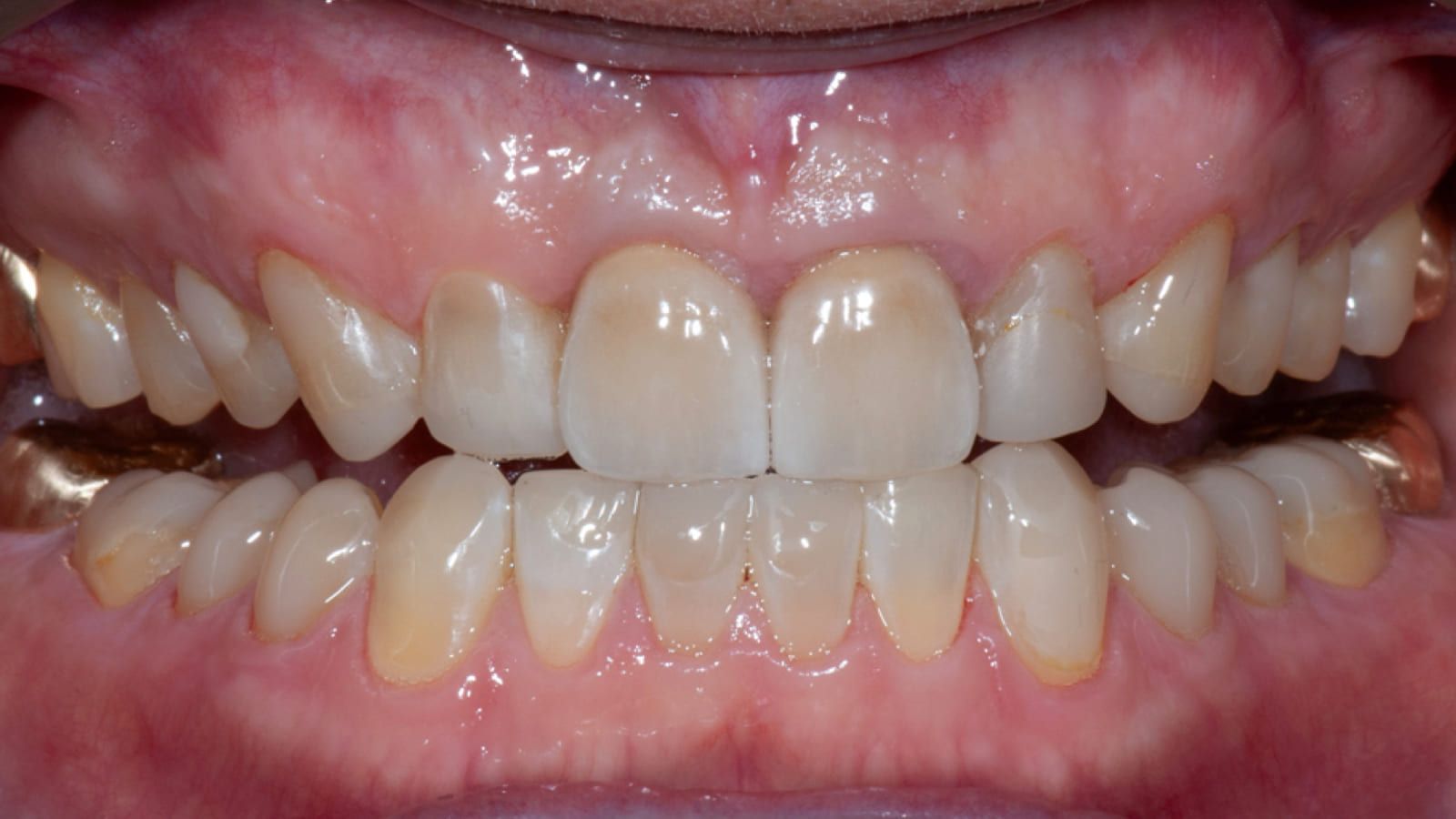 Staged Full-Mouth Reconstruction — after treatment