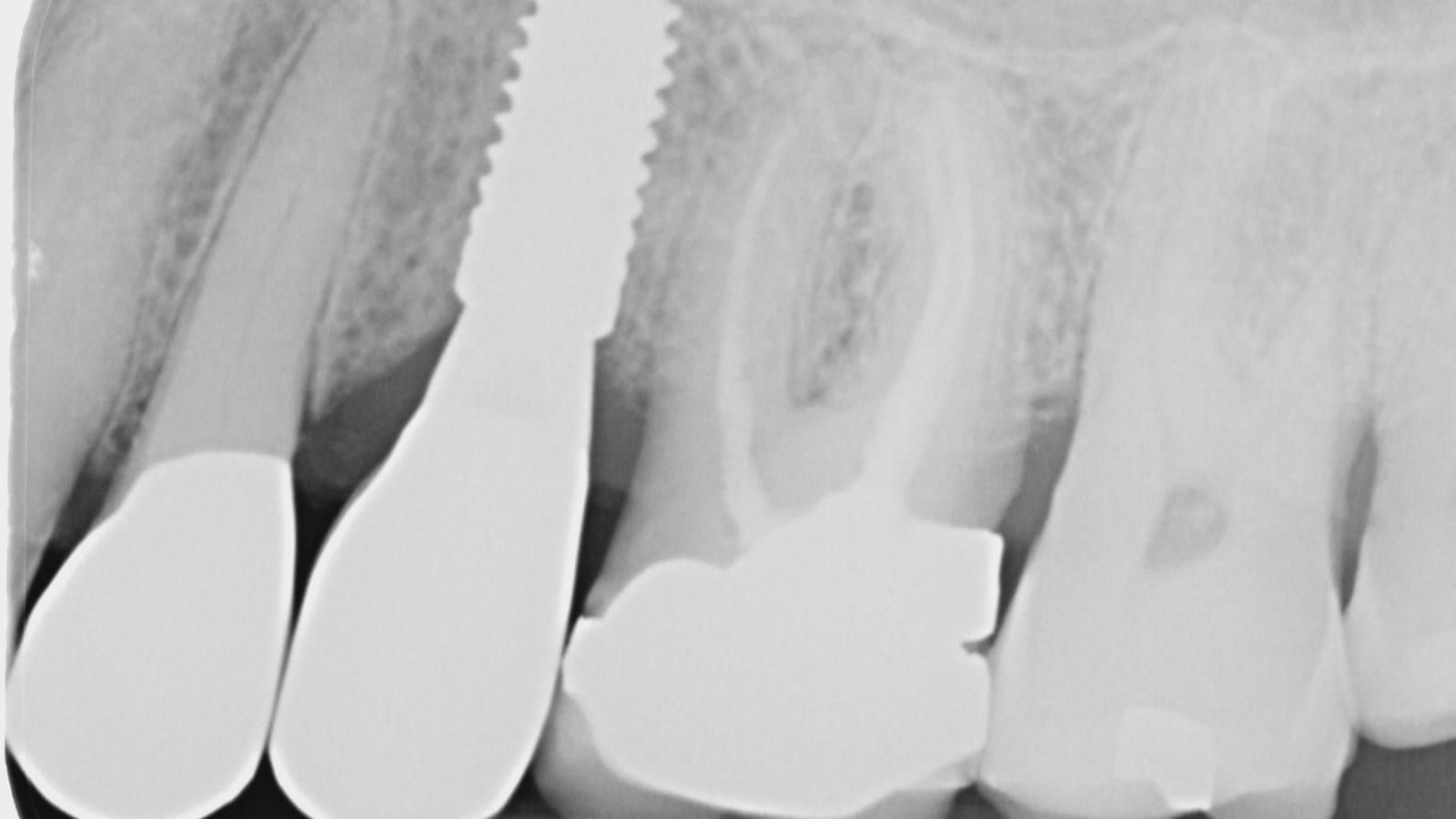 An Implant Crown Beside a Zirconia Crown — after treatment