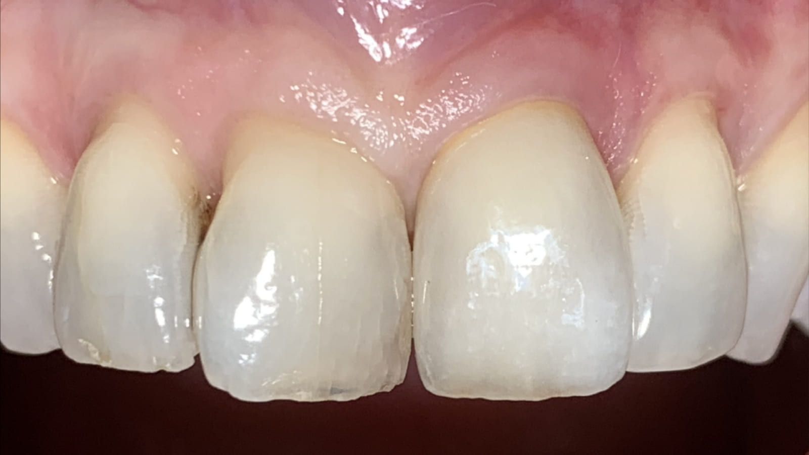 An All-Ceramic Crown Replacing a Metal-Backed One — after treatment