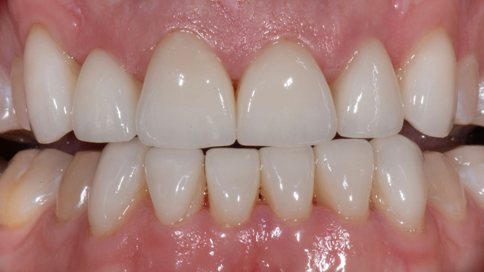 A Two-Decade Full-Mouth Rehabilitation — after treatment