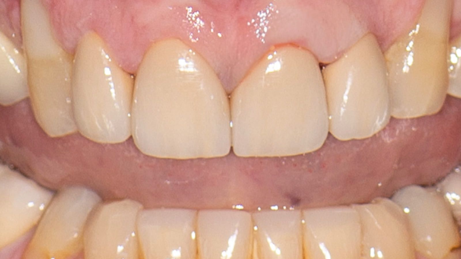 Porcelain Crowns for Severe Gum Recession — after treatment