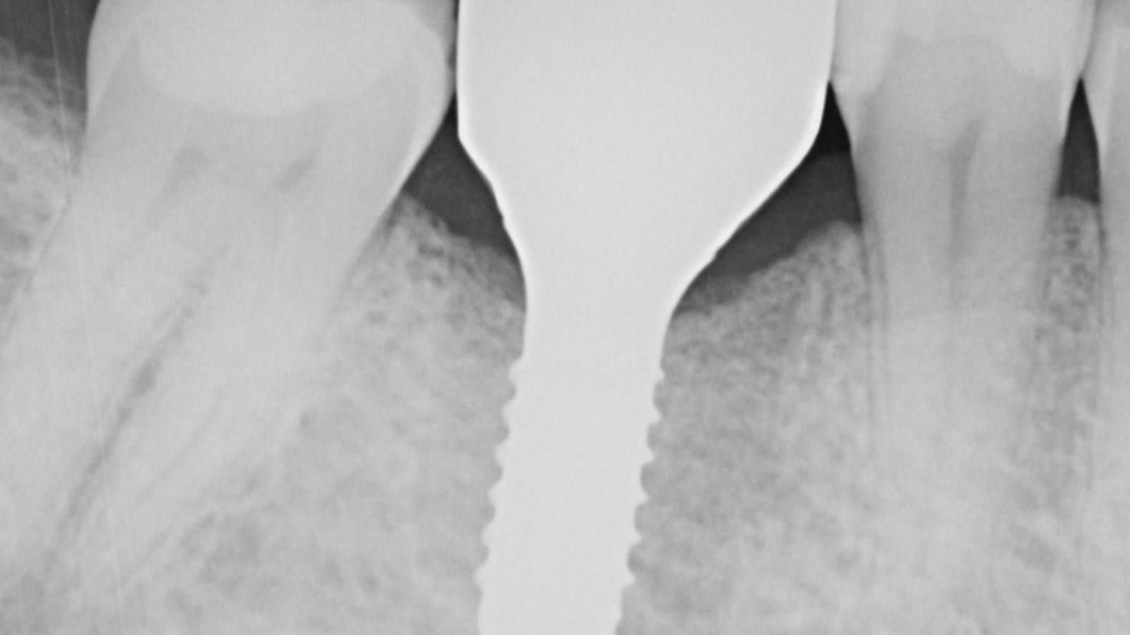 An Implant Crown for a Split Molar — after treatment