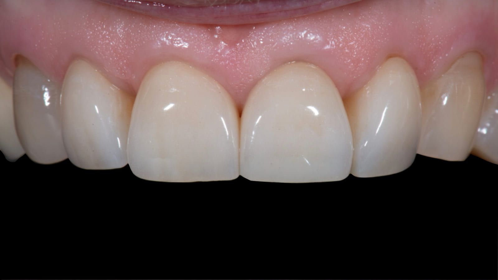 Porcelain Crowns After Years of Repairs — after treatment