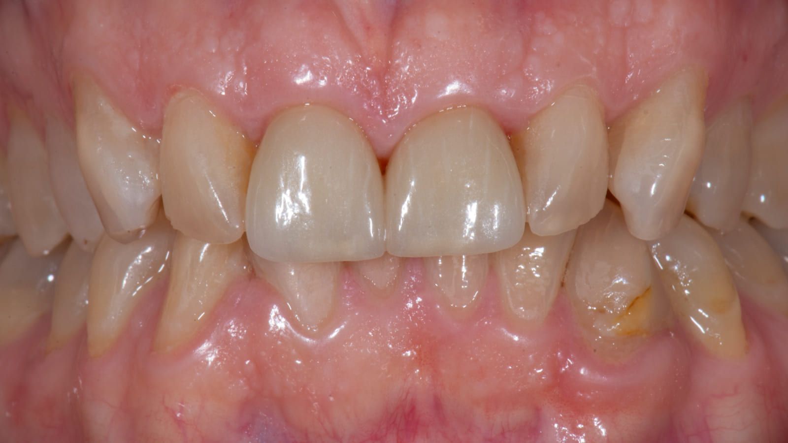 Ceramic Crowns After Acid Erosion — after treatment