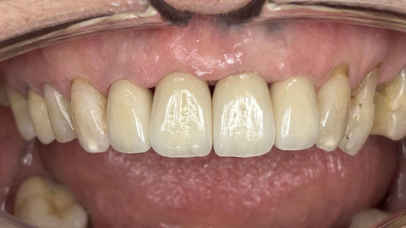 Four All-Ceramic Crowns for Broken Front Teeth — after treatment