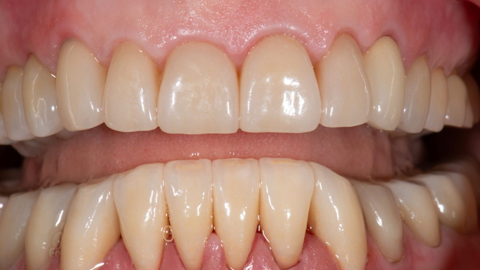 Full-Mouth Rehabilitation with Crowns & Veneers — after treatment
