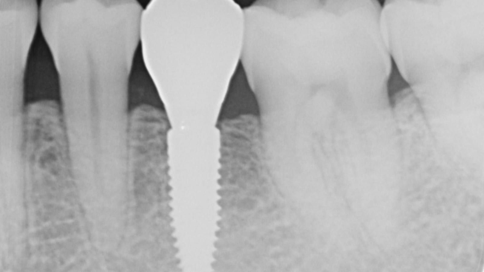 An Implant Crown After Orthodontic Treatment — after treatment