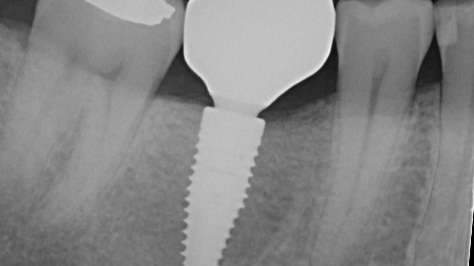 An Implant Crown After a Failed Root Canal — after treatment