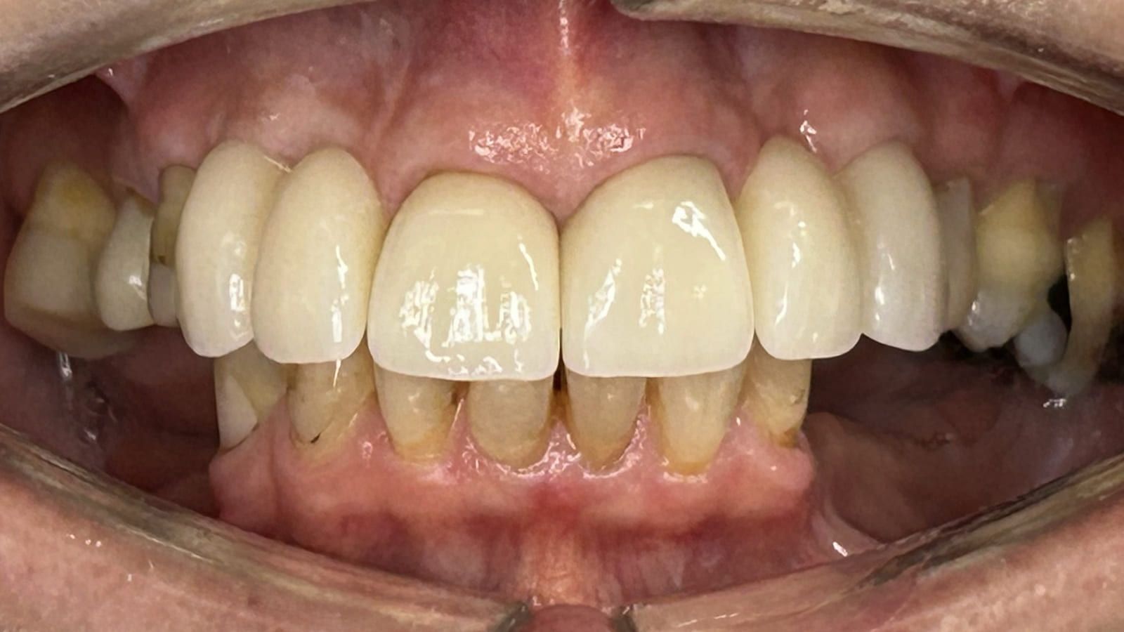 Implant Bridges & Crowns Replacing Failed Work — after treatment