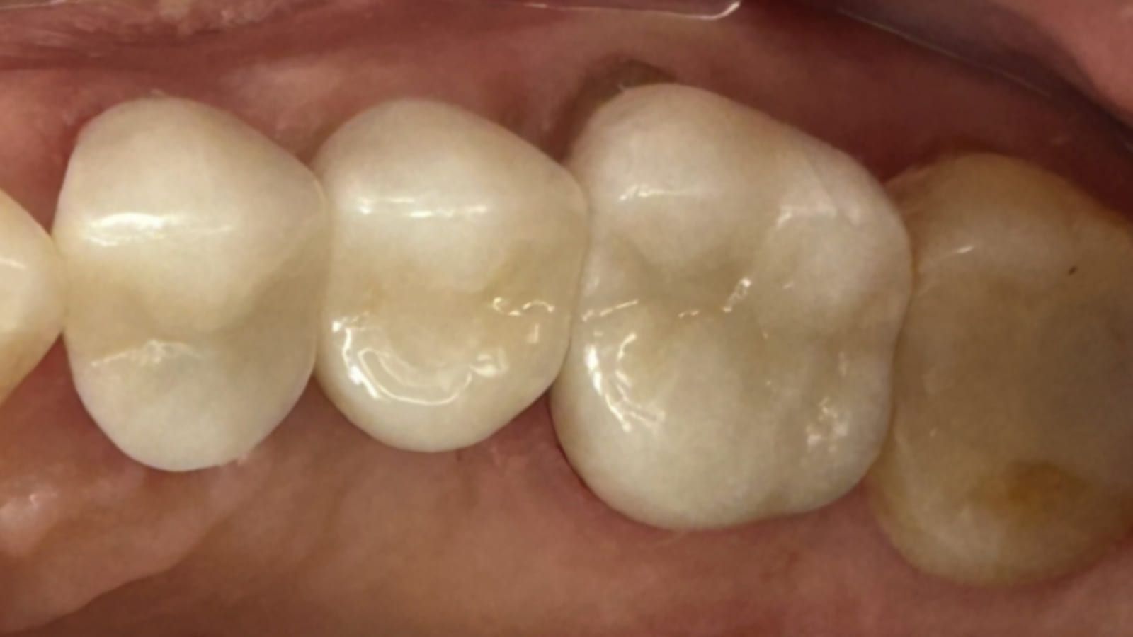 A Failing Bridge Converted to Crowns & an Implant — after treatment