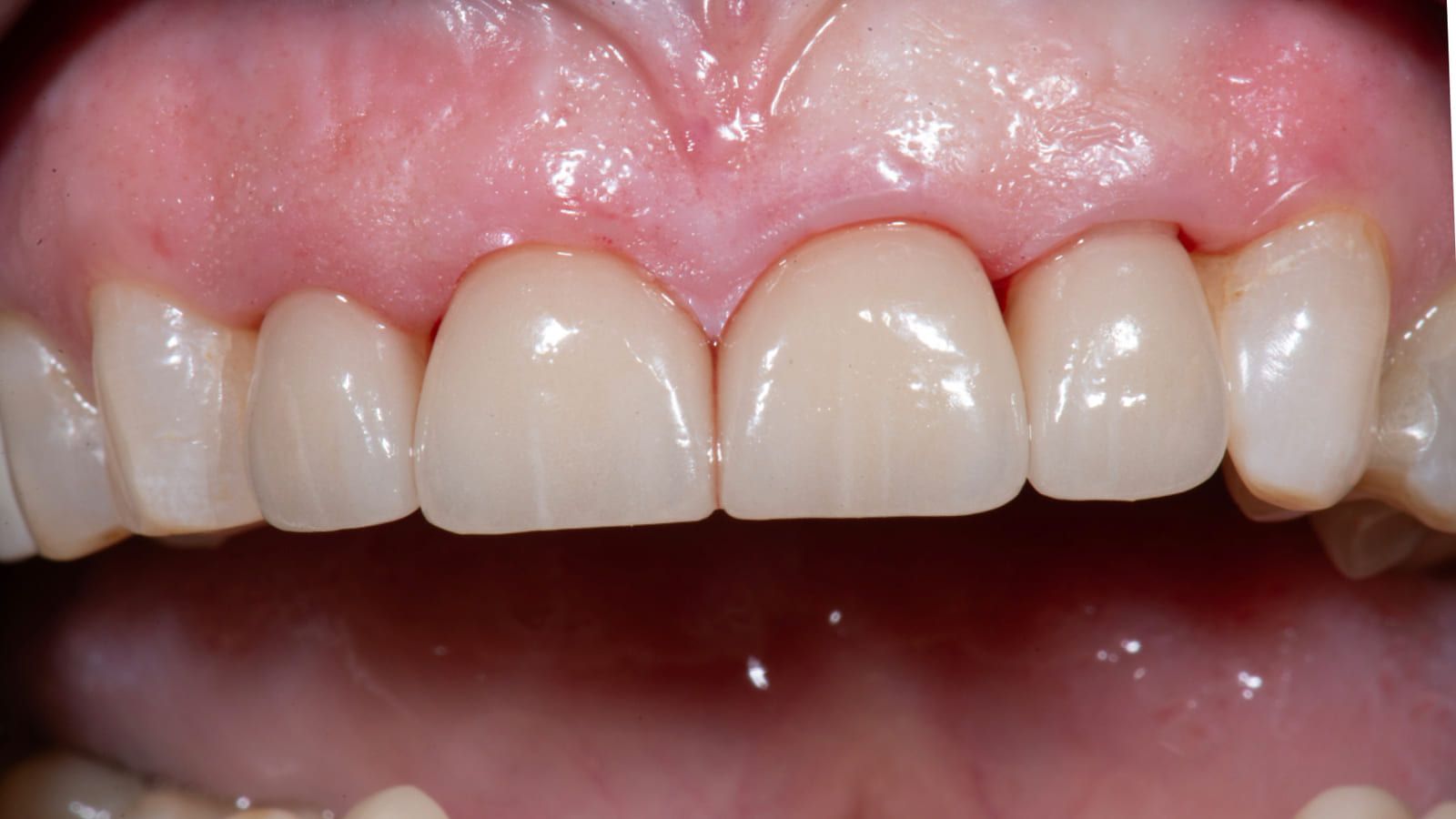 Ceramic Crowns for Four Worn Front Teeth — after treatment