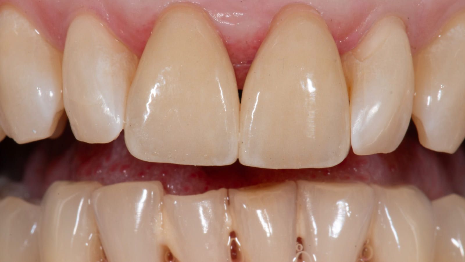 Porcelain Veneers After Childhood Trauma — after treatment