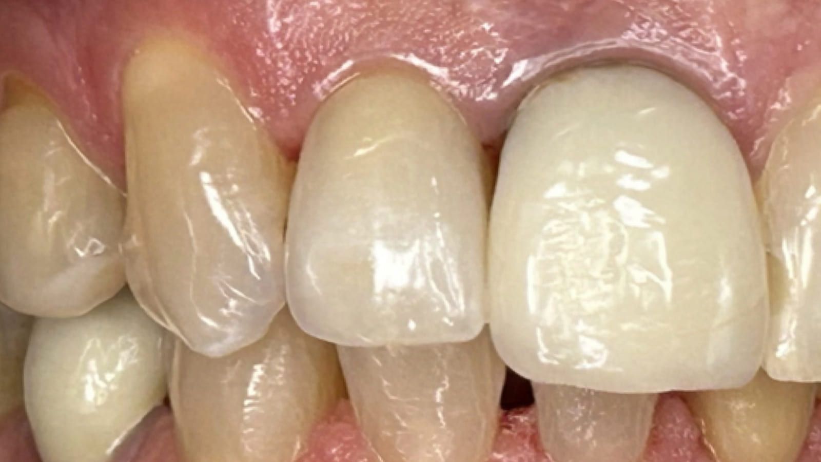 Replacing a Hopeless Front Tooth with an Implant — after treatment