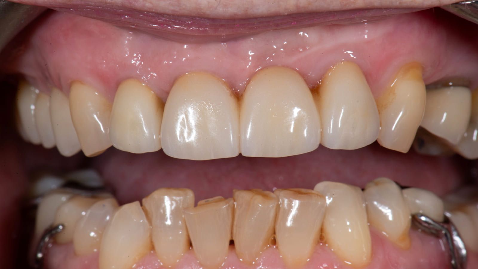 Ceramic Bridge & Crown Replacement — after treatment