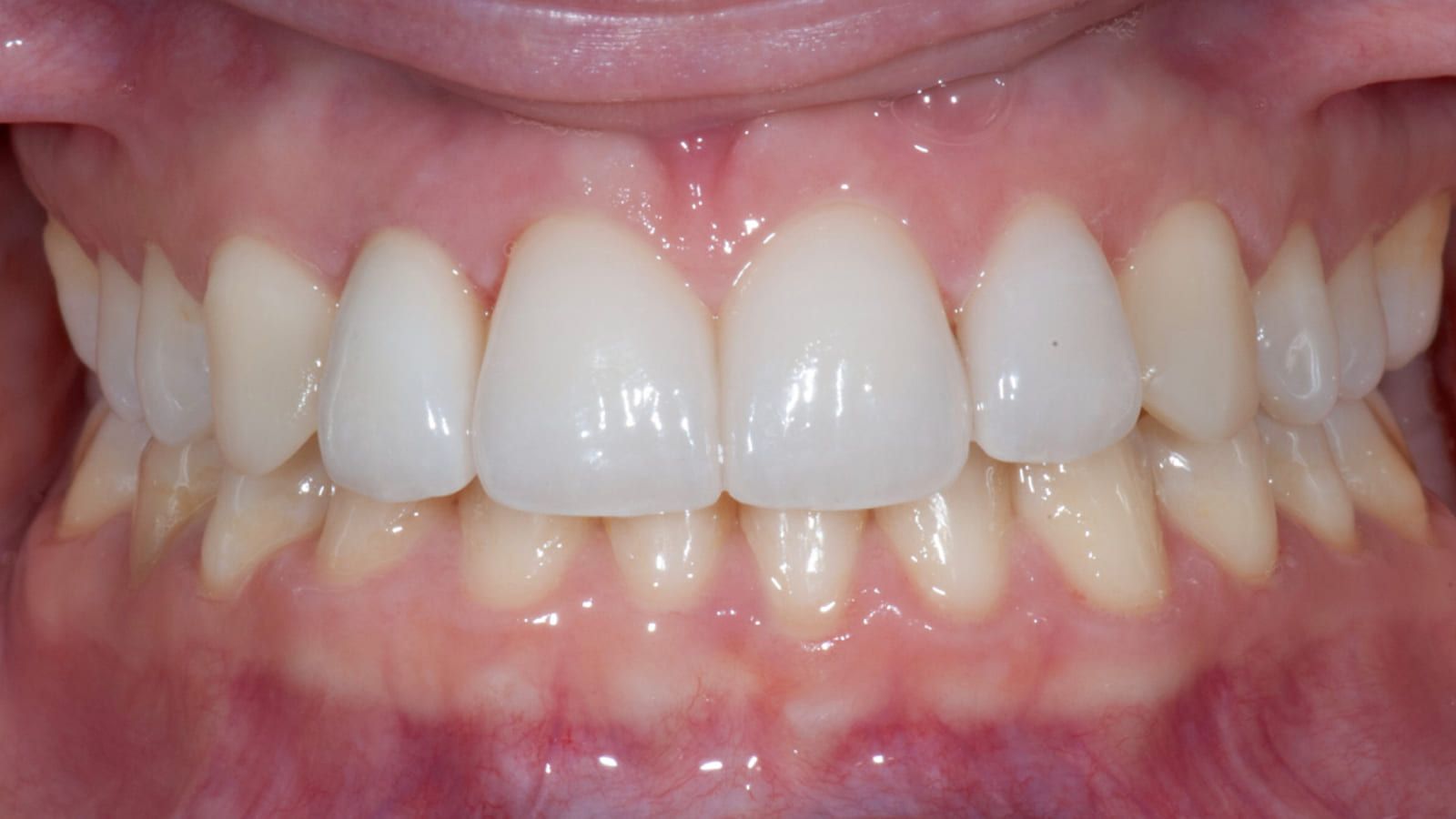 Implant & Veneers for a Missing Lateral Incisor — after treatment