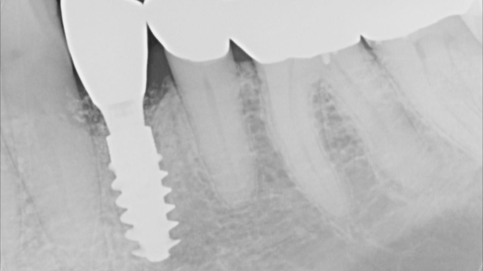 An Implant Crown for an Unrestorable Tooth — after treatment