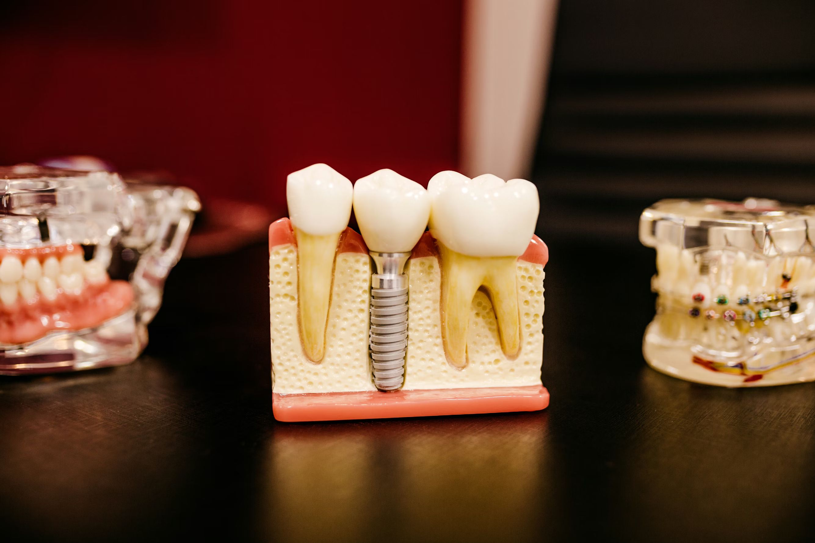 Are Dental Implants Right for You? Pros, Cons, and Candidacy