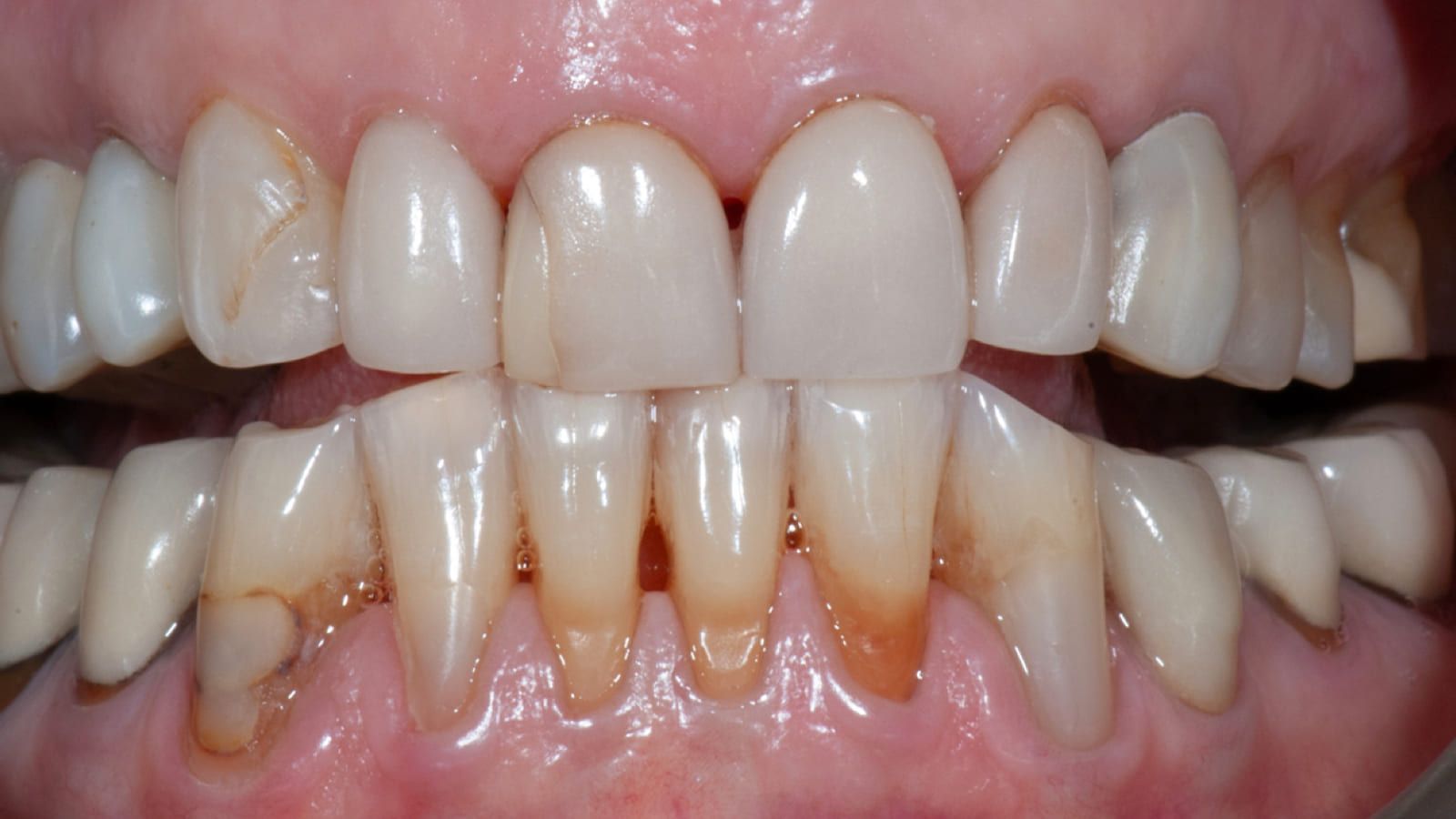 Full-Mouth Rehabilitation with Crowns & Veneers — before treatment