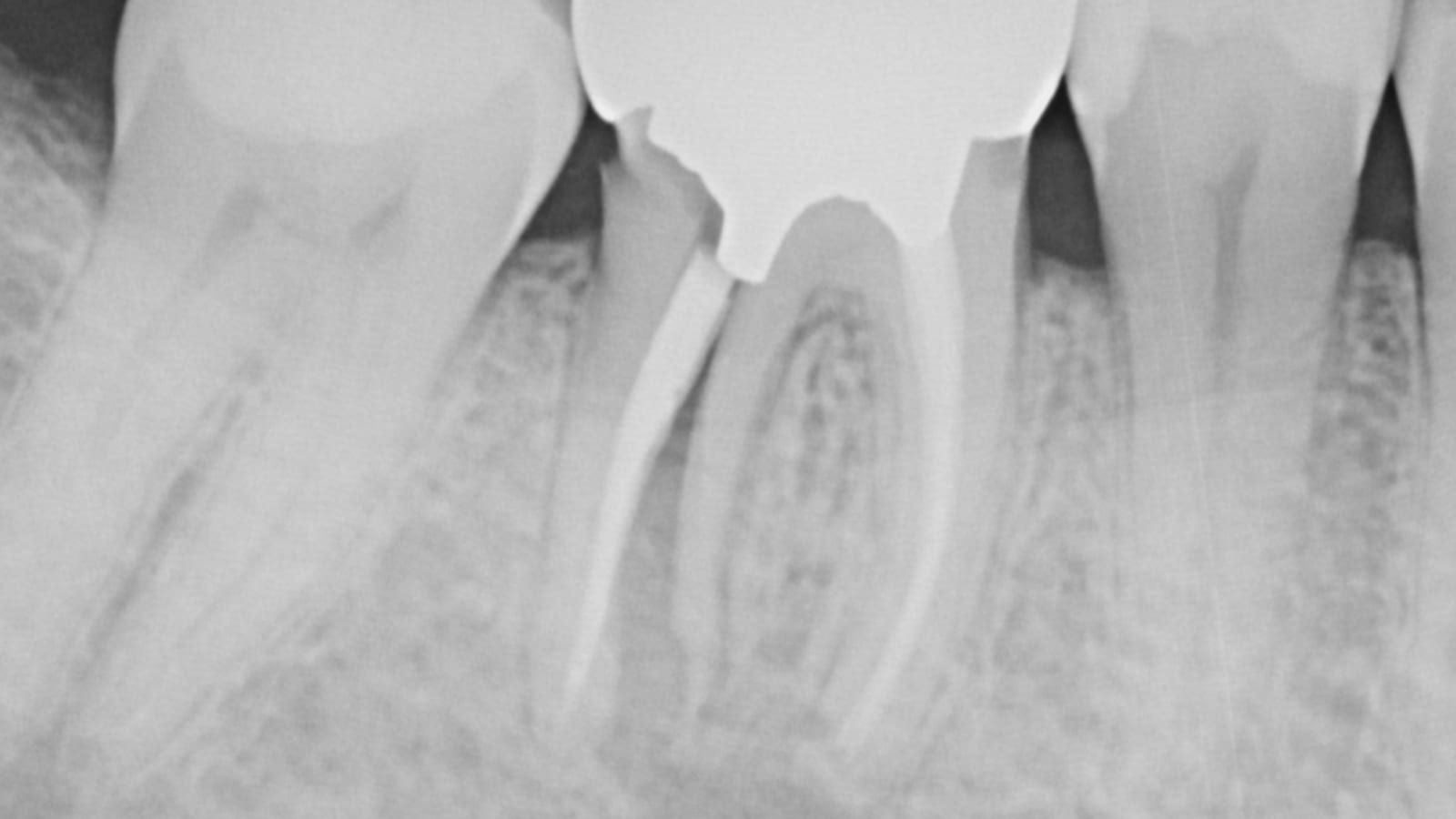 An Implant Crown for a Split Molar — before treatment