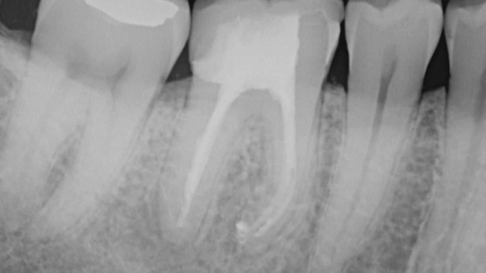 An Implant Crown After a Failed Root Canal — before treatment