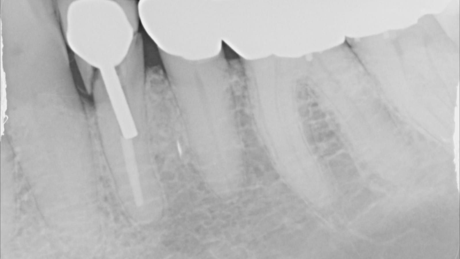An Implant Crown for an Unrestorable Tooth — before treatment