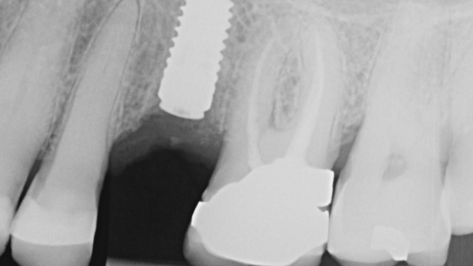 An Implant Crown Beside a Zirconia Crown — before treatment