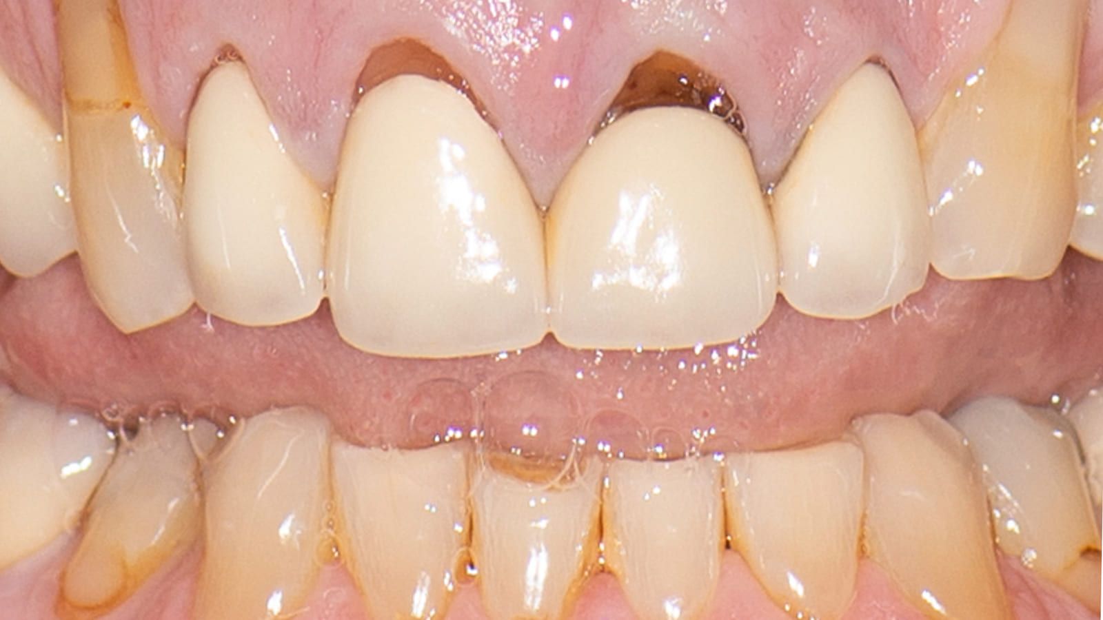 Porcelain Crowns for Severe Gum Recession — before treatment