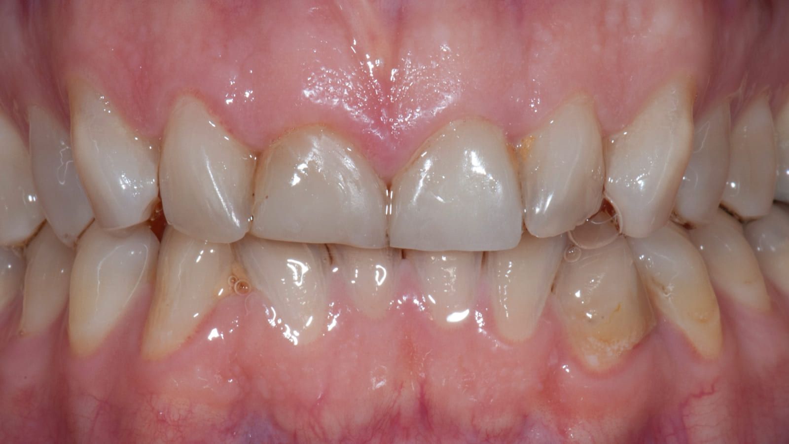 Ceramic Crowns After Acid Erosion — before treatment