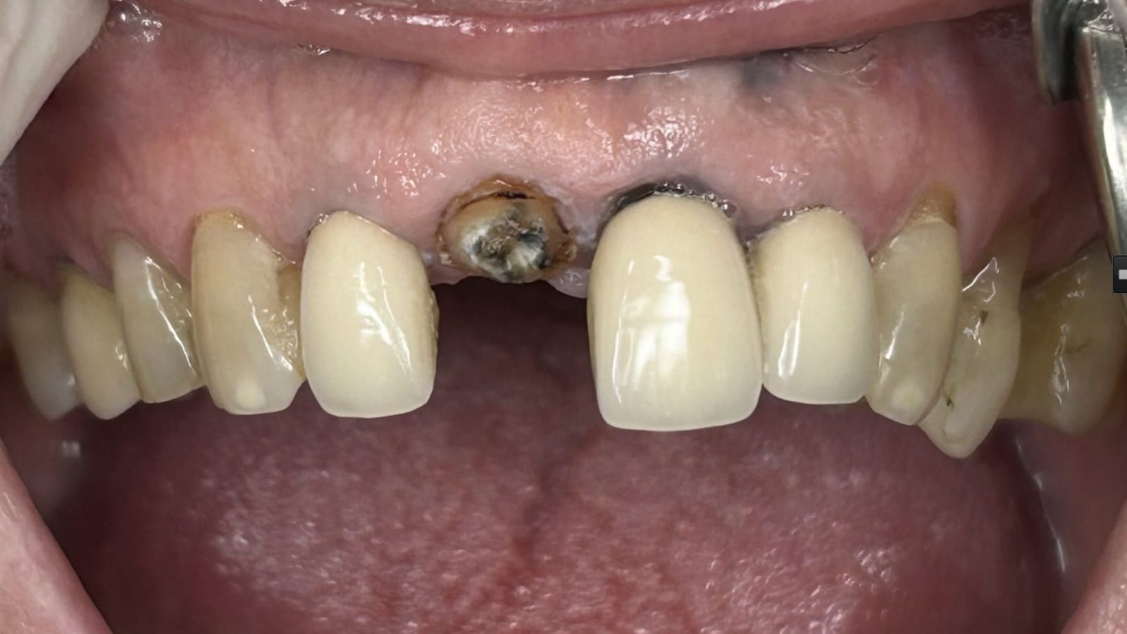 Four All-Ceramic Crowns for Broken Front Teeth — before treatment