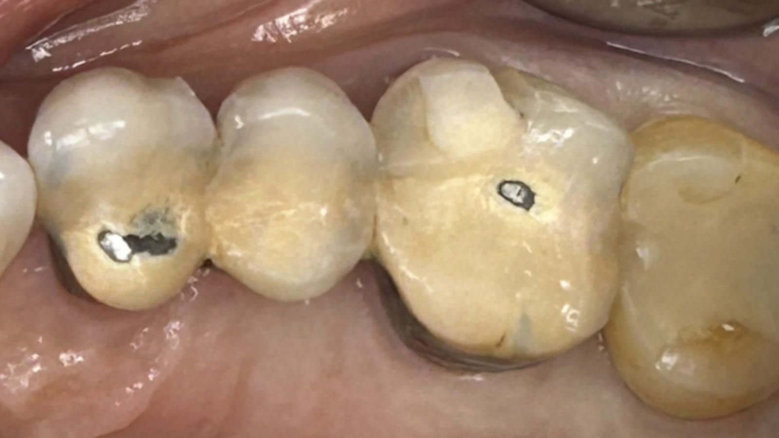 A Failing Bridge Converted to Crowns & an Implant — before treatment