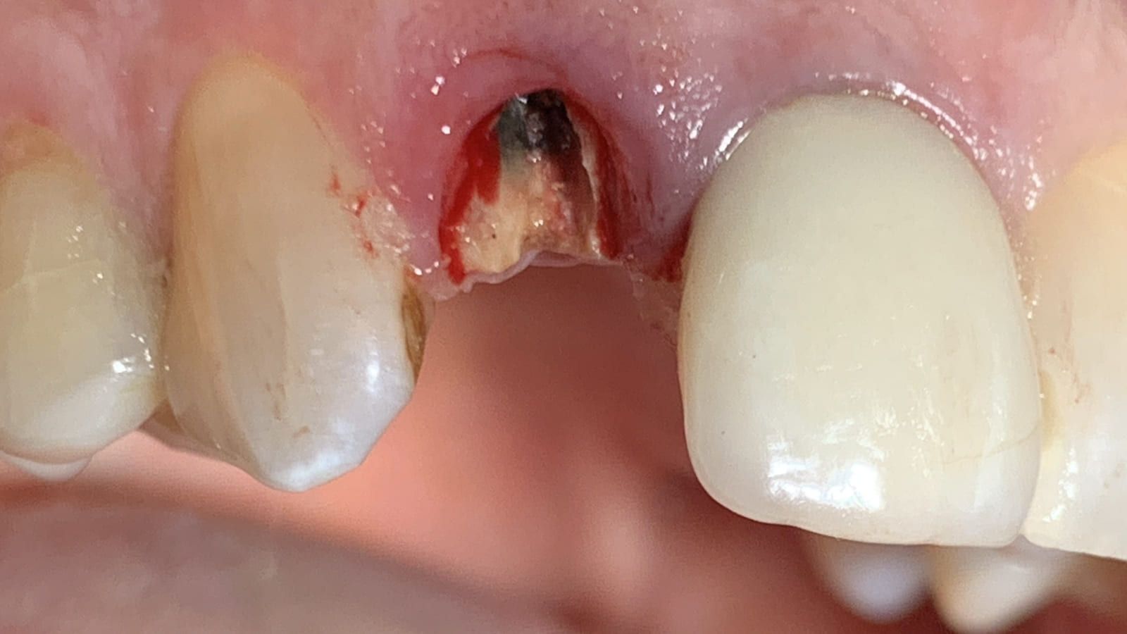 Replacing a Hopeless Front Tooth with an Implant — before treatment