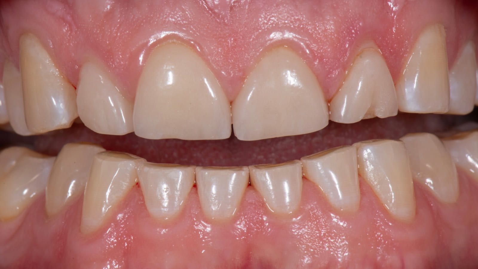 A Two-Decade Full-Mouth Rehabilitation — before treatment