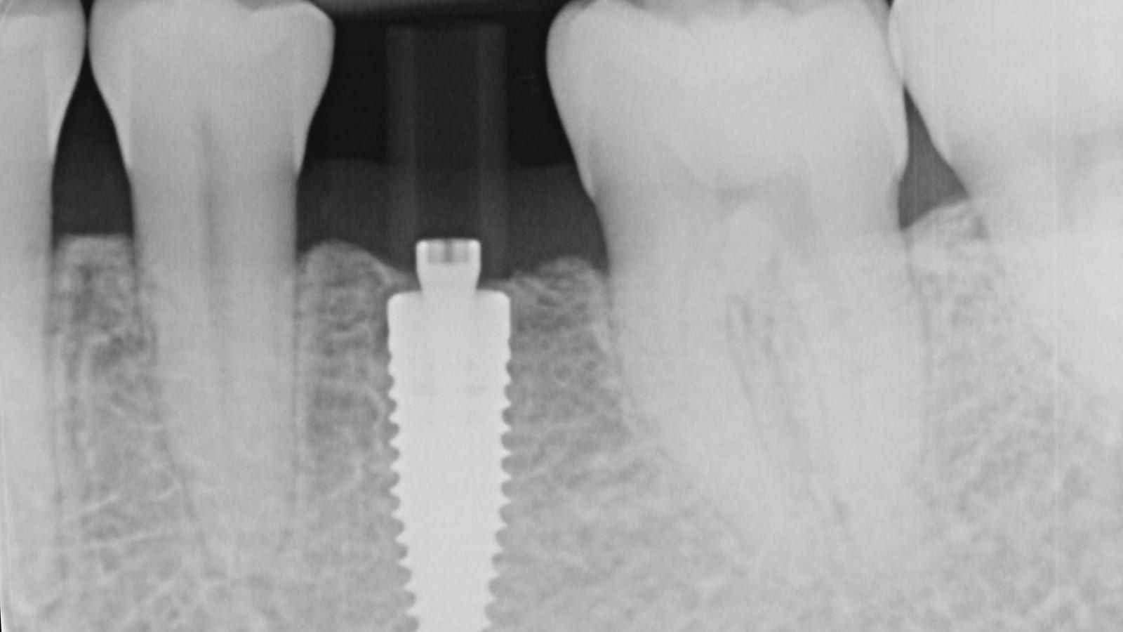 An Implant Crown After Orthodontic Treatment — before treatment