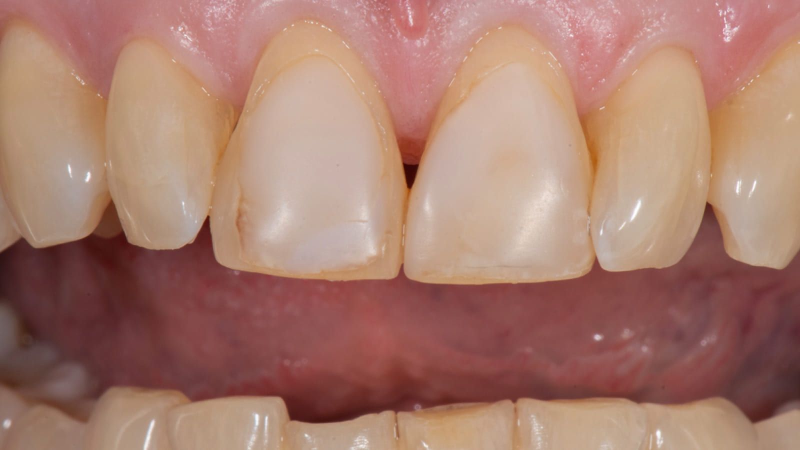 Porcelain Veneers After Childhood Trauma — before treatment