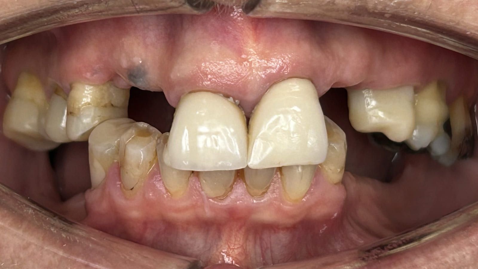 Implant Bridges & Crowns Replacing Failed Work — before treatment