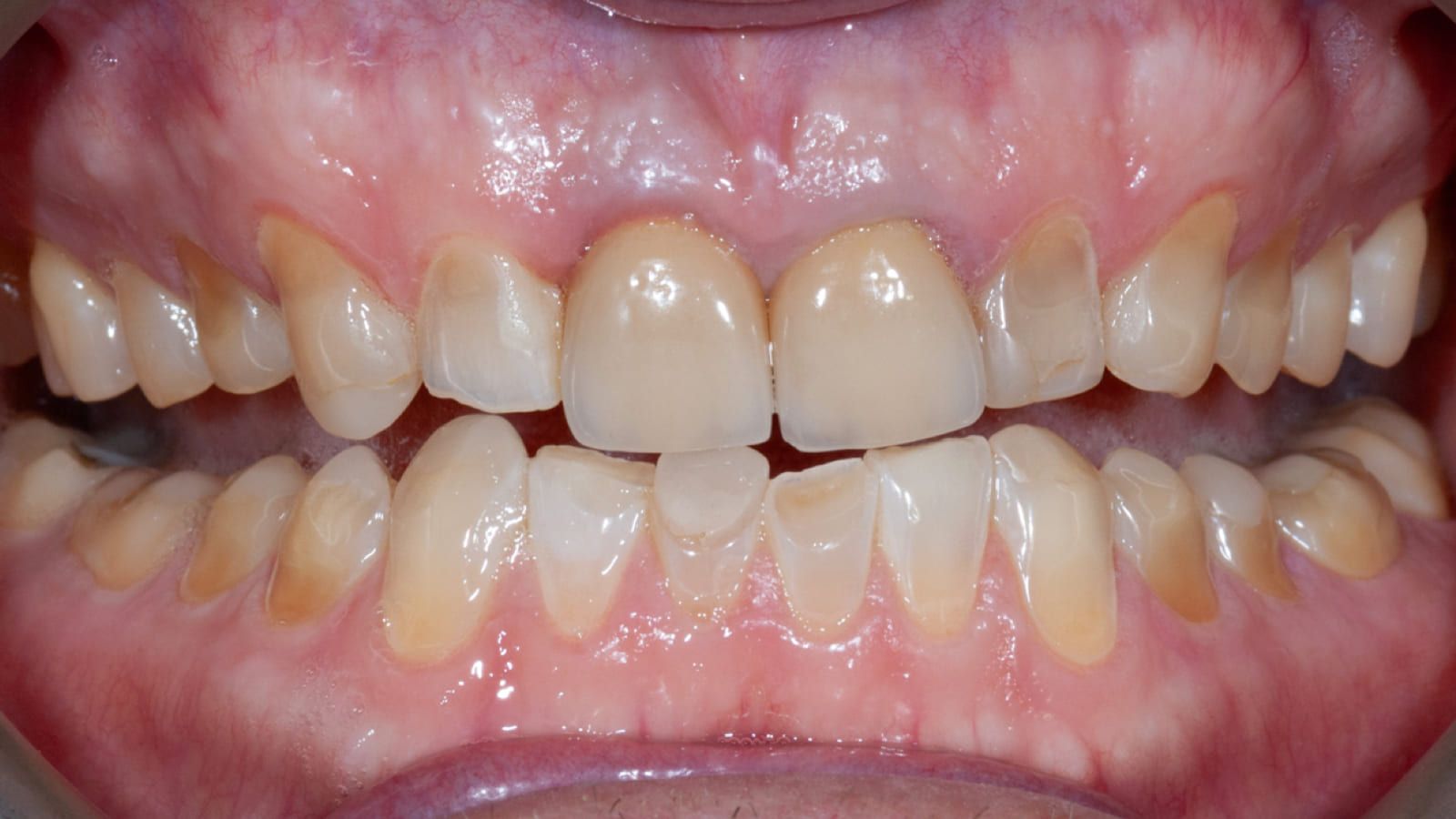 Staged Full-Mouth Reconstruction — before treatment