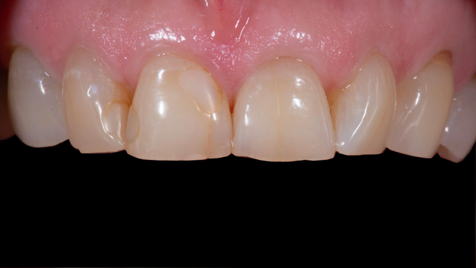 Porcelain Crowns After Years of Repairs — before treatment