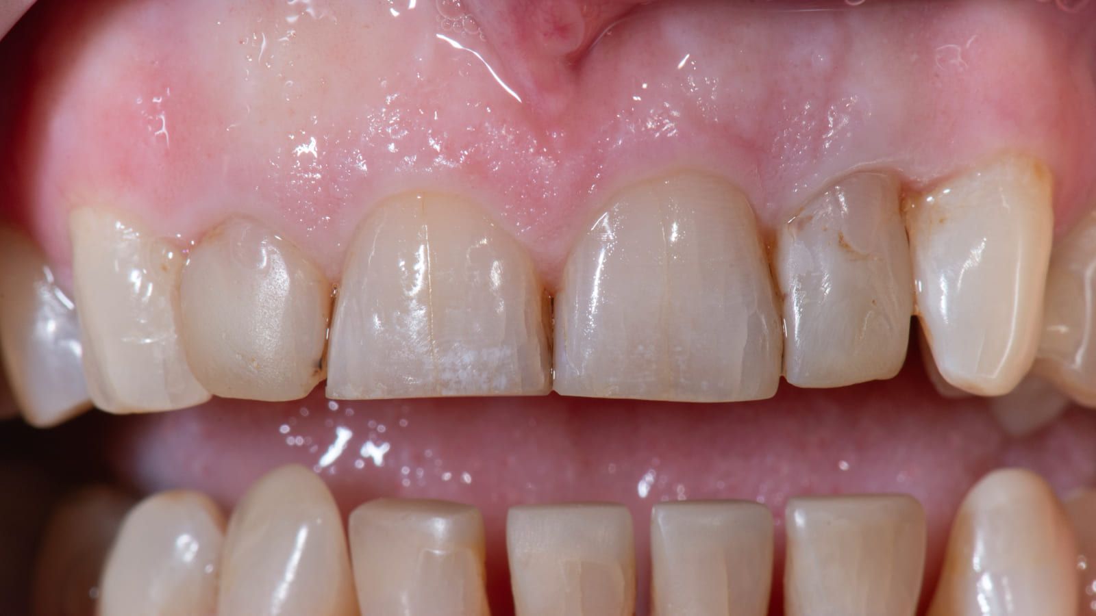 Ceramic Crowns for Four Worn Front Teeth — before treatment